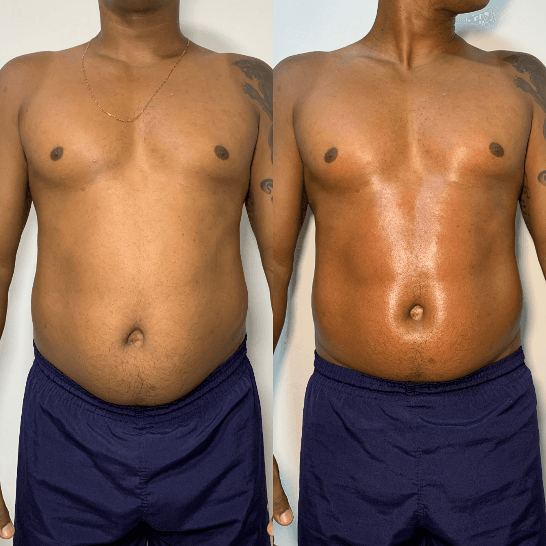 Resultado de tratamento corporal - Antes e Depois